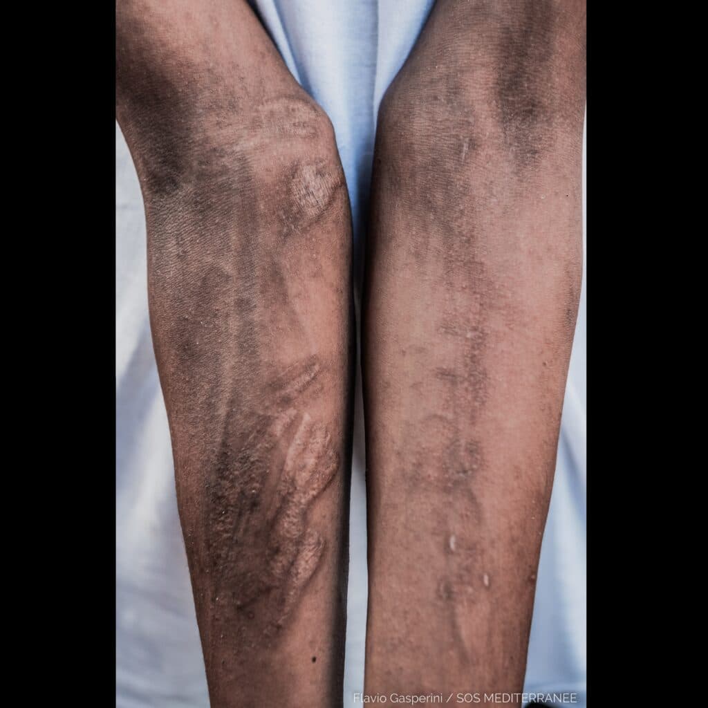 [TÉMOIGNAGE] « Chaque matin, ils nous battaient. Regardez mes bras, mes cicatrices. », Sabtou*, rescapé à bord de l’Ocean Viking SOS Méditerranée