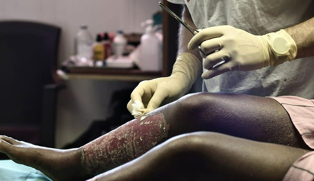 3 QUESTIONS À Rebecca – Dépister les brûlures dues au carburant : un impératif